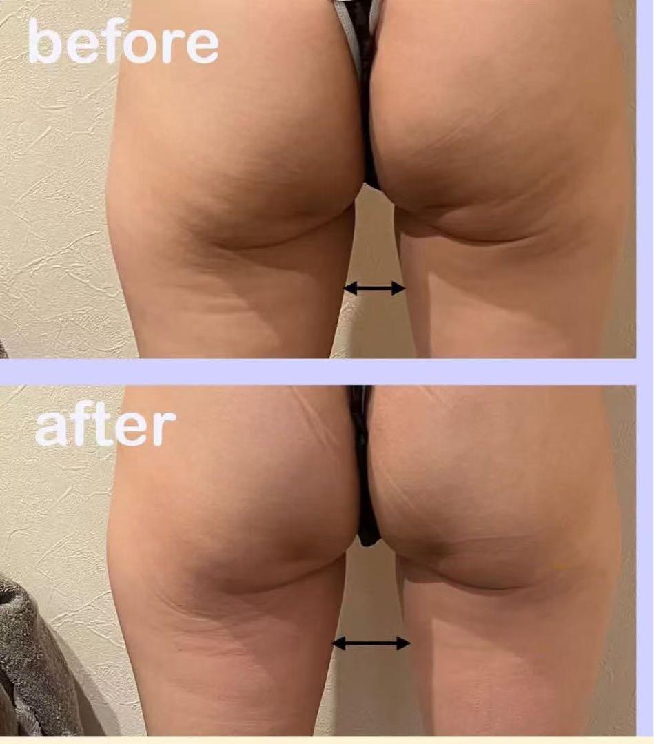 脂肪冷却と電磁パルス４本ハンドル痩身機器