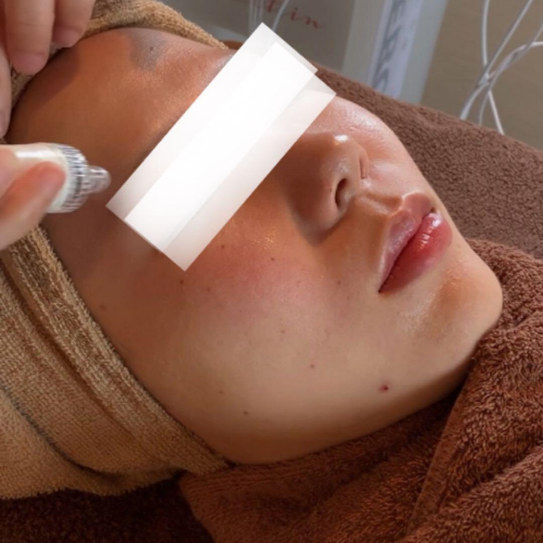 フェイシャル業務用　毛穴洗浄ハイドロマシン　専用美容マスク20枚入りプレゼント！