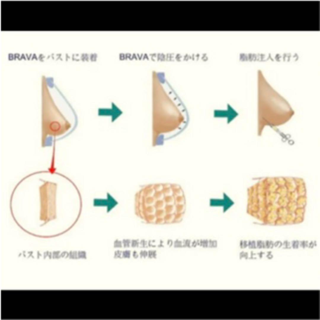 ⭐️半額以下‼︎‼︎⭐️ビブラ/豊胸/BEbraコンデンスリッチ/脂肪注入/バストアップ